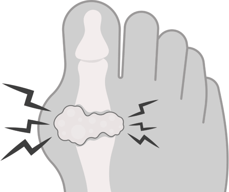 bunions