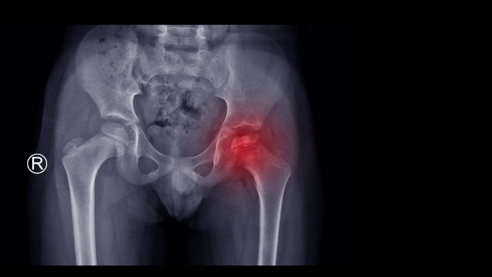 An X-ray of a person's hip
