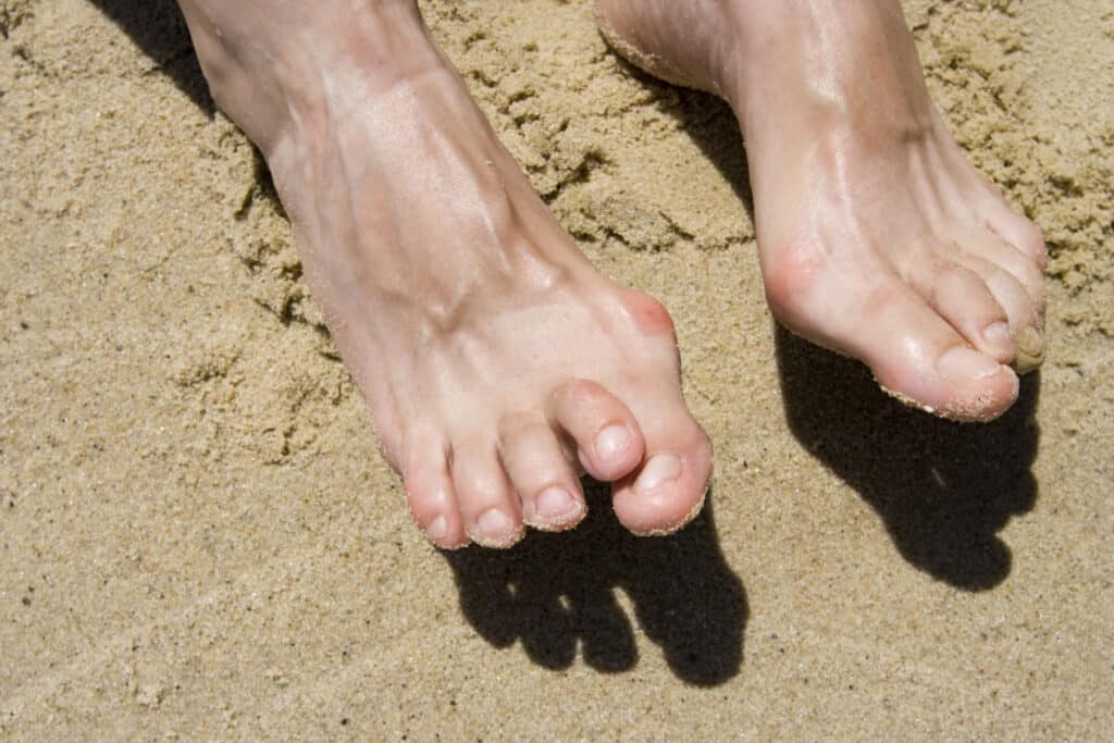 A person's feed in sand, with hammertoe developing on one foot.